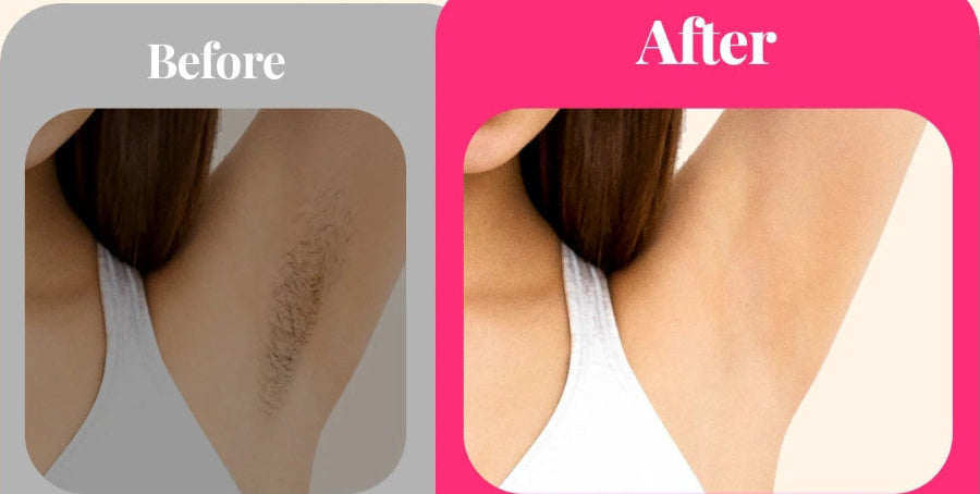 Laser Beauty Pro – Épilateur IPL Haute Performance